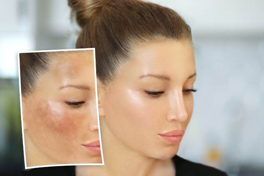 Melanin là sắc tố quyết định màu sắc của da, tóc, và mắt