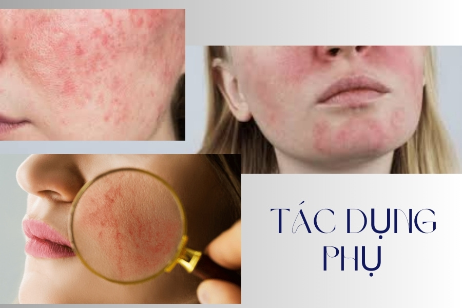 Mandelic Acid trị mụn tốt không?