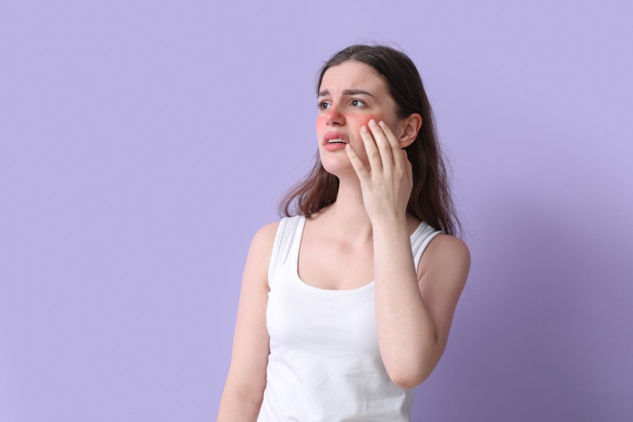 Chàm da là một trong những bệnh lý phổ biến dẫn đến tình trạng dị ứng mặt Dị ứng nổi mẩn ở mặt do bệnh chàm