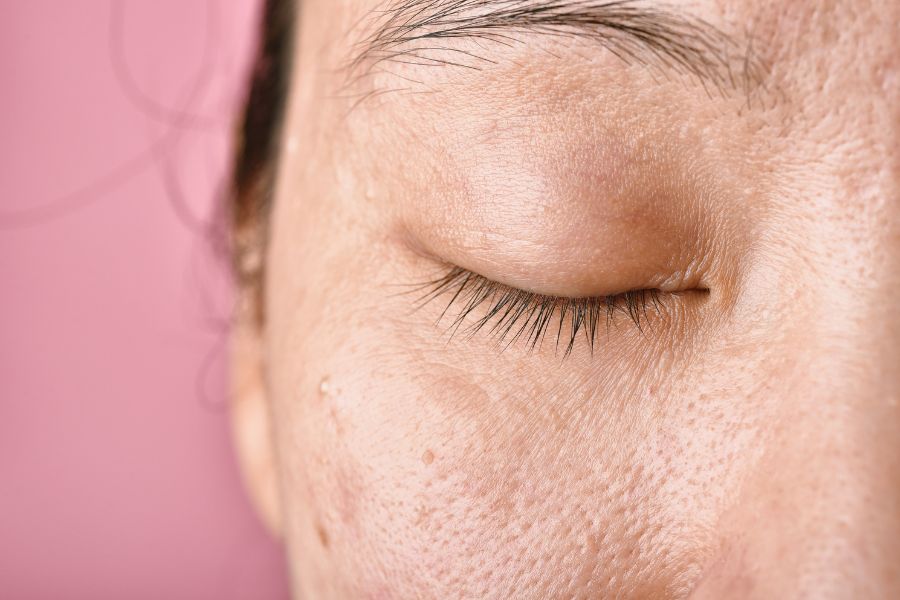 Lông mày có thể bị nhiều loại mụn khác nhau, từ nhẹ đến nặng Lông mày có thể bị nhiều loại mụn khác nhau, từ nhẹ đến nặng