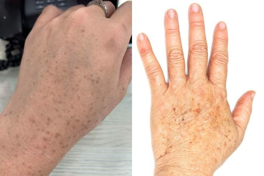 Bàn tay nổi đốm nâu do lạm dụng mỹ phẩm