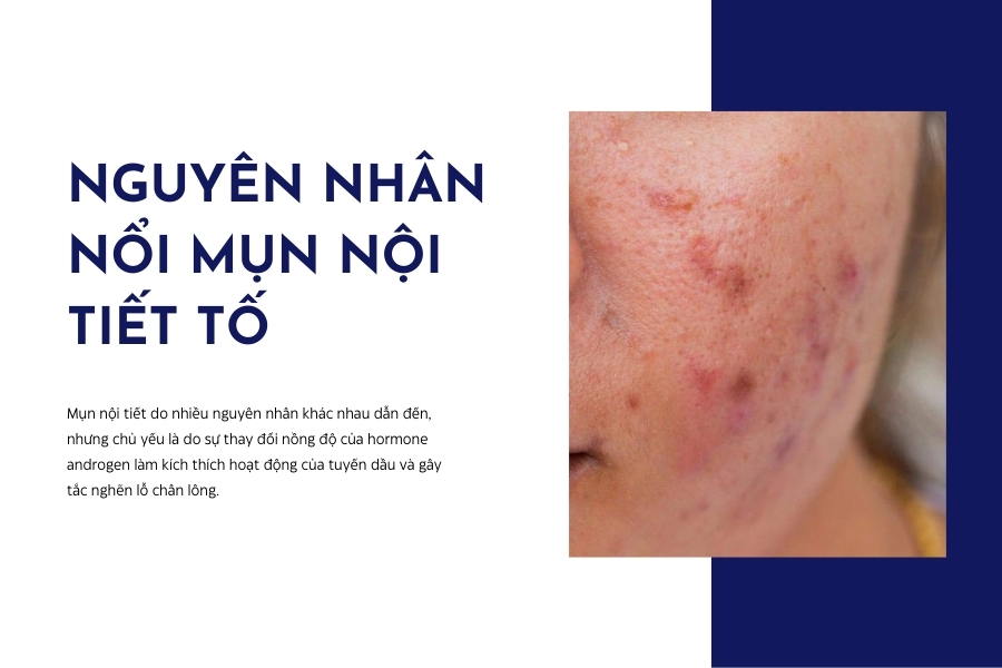 Nguyên nhân gây mụn nội tiết ở nam và nữ là gì? Nguyên nhân gây mụn nội tiết ở nam và nữ là gì?