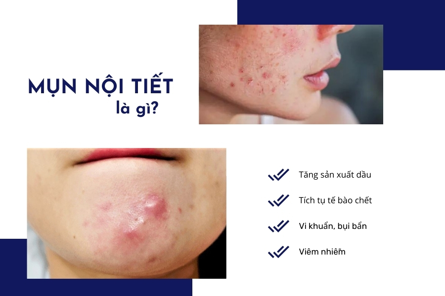 Tìm hiểu mụn nội tiết là gì Tìm hiểu mụn nội tiết là gì