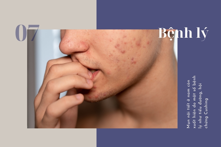 Mụn nội tiết ở nam hình thành do nhiều nguyên nhân khác nhau Mụn nội tiết ở nam hình thành do nhiều nguyên nhân khác nhau