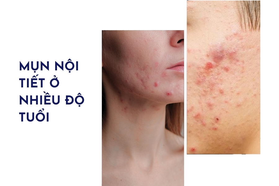 Mụn do thay đổi nội tiết tố có thể xảy ra với bất kỳ ai Mụn do thay đổi nội tiết tố có thể xảy ra với bất kỳ ai