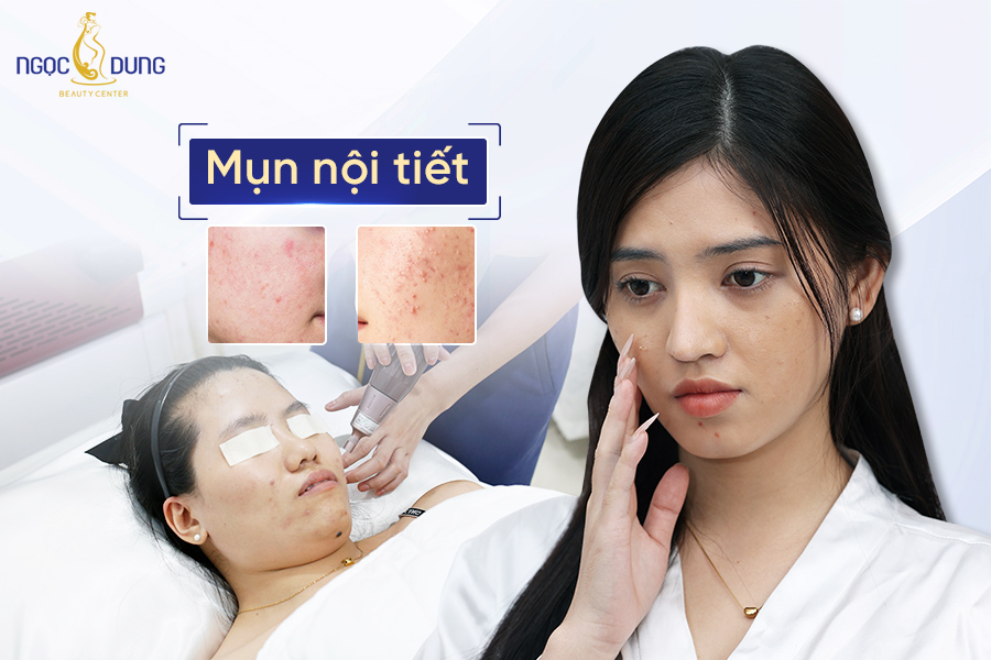 Mụn nội tiết là gì? Nguyên nhân, dấu hiệu và cách điều trị