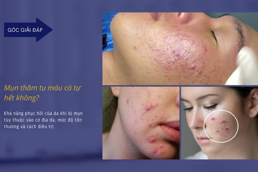 Mụn thâm tụ máu có tự hết không? Mụn thâm tụ máu có tự hết không?