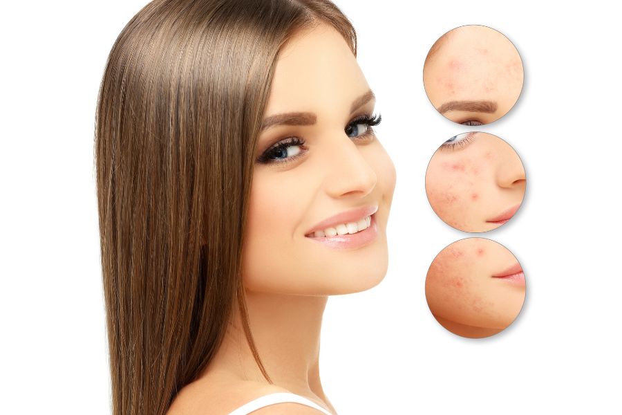 Đắp mặt nạ đúng cách còn hỗ trợ trị mụn trứng cá và mụn đầu đen hiệu quả