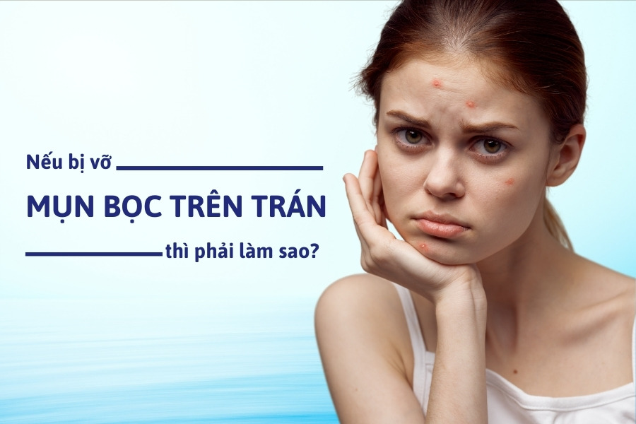 Nên đến cơ sở uy tín để được hỗ trợ nhanh chóng nếu mụn bọc bị vỡ Nên đến cơ sở uy tín để được hỗ trợ nhanh chóng nếu mụn bọc bị vỡ