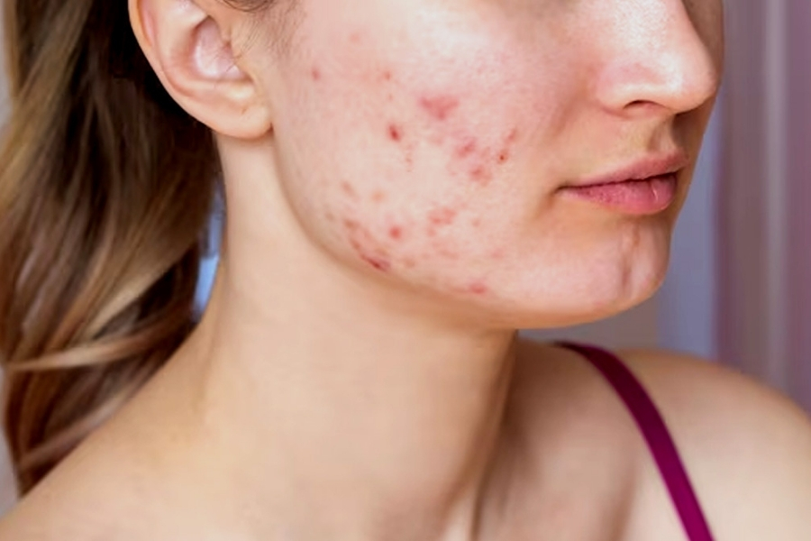 Mụn nội tiết mọc ở đâu nhiều nhất? Mụn nội tiết mọc ở đâu nhiều nhất?