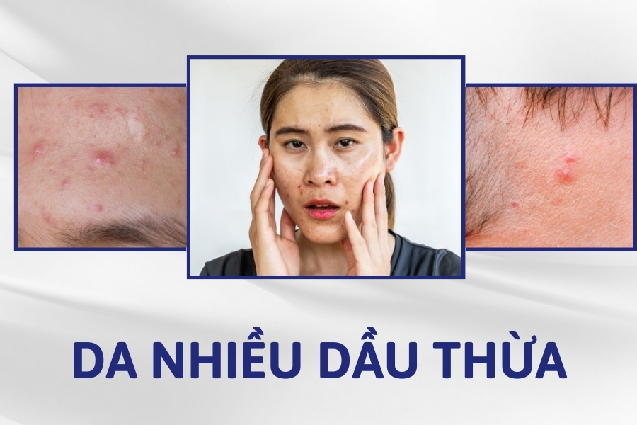 Trán là vị trí tiết dầu nhiều nên rất dễ nổi mụn khi không được chăm sóc đúng cách Trán là vị trí tiết dầu nhiều nên rất dễ nổi mụn khi không được chăm sóc đúng cách