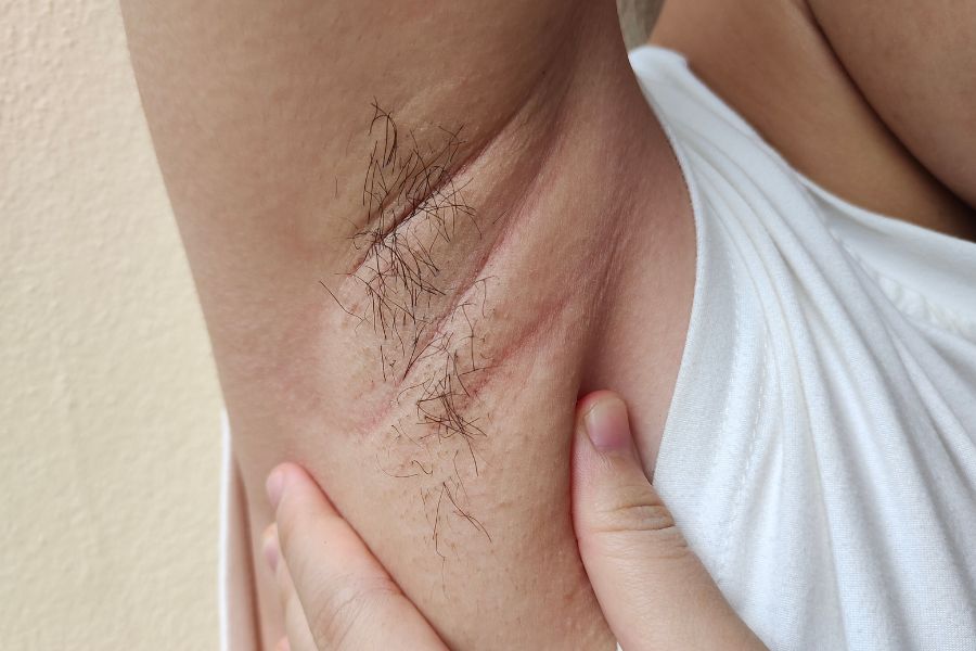 Nách bị nổi hạch sau khi nhổ lông có nguy hiểm không