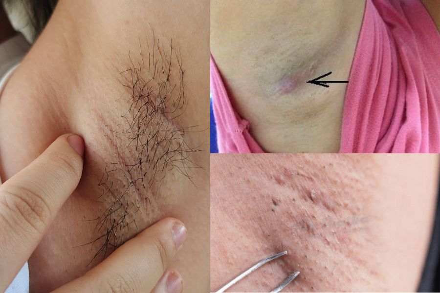 Hạch bạch huyết bị phình to do tình trạng nhiễm trùng vì nhổ lông nách