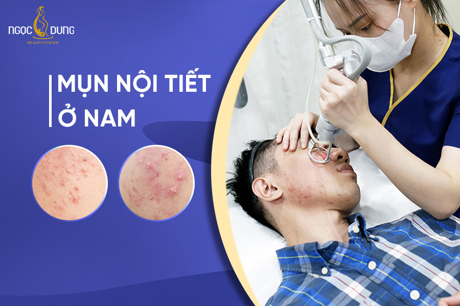 Mụn nội tiết ở nam: Nguyên nhân, dấu hiệu và cách điều trị