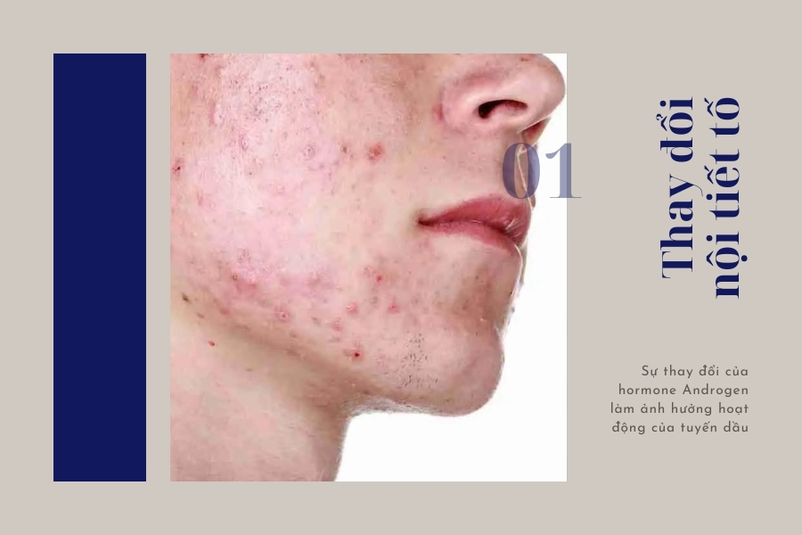 Thay đổi nội tiết tố là nguyên nhân gây mụn ở nam giới Thay đổi nội tiết tố là nguyên nhân gây mụn ở nam giới