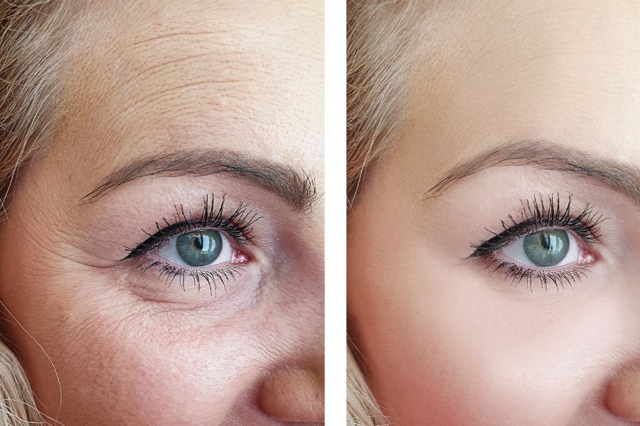 Tác dụng của trái bơ hỗ trợ làm mờ nếp nhăn