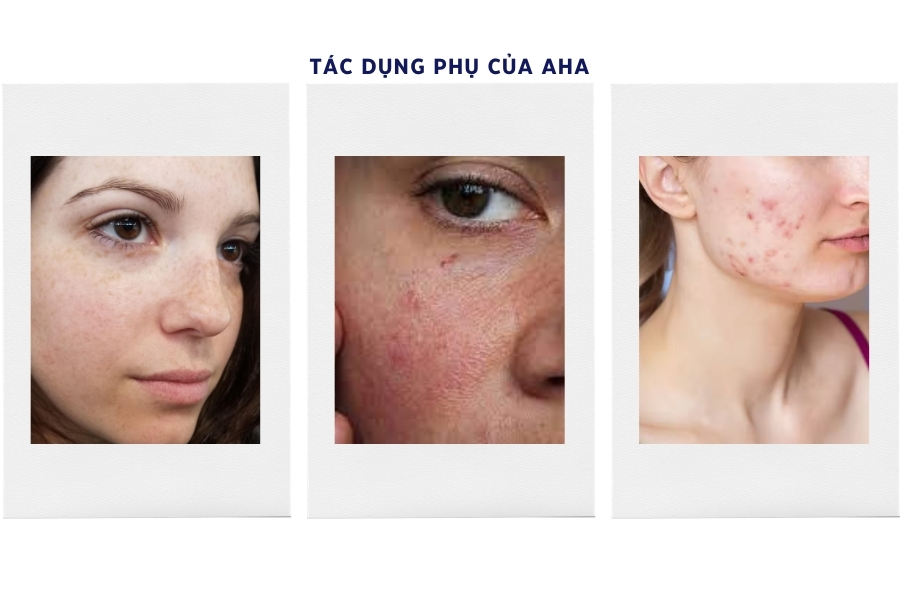 Tác dụng phụ của AHA là gì? Tác dụng phụ của AHA là gì?
