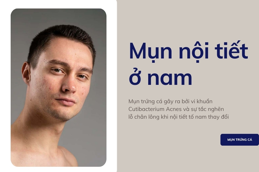 Mụn nội tiết tố ở nam giới là gì? Mụn nội tiết tố ở nam giới là gì?