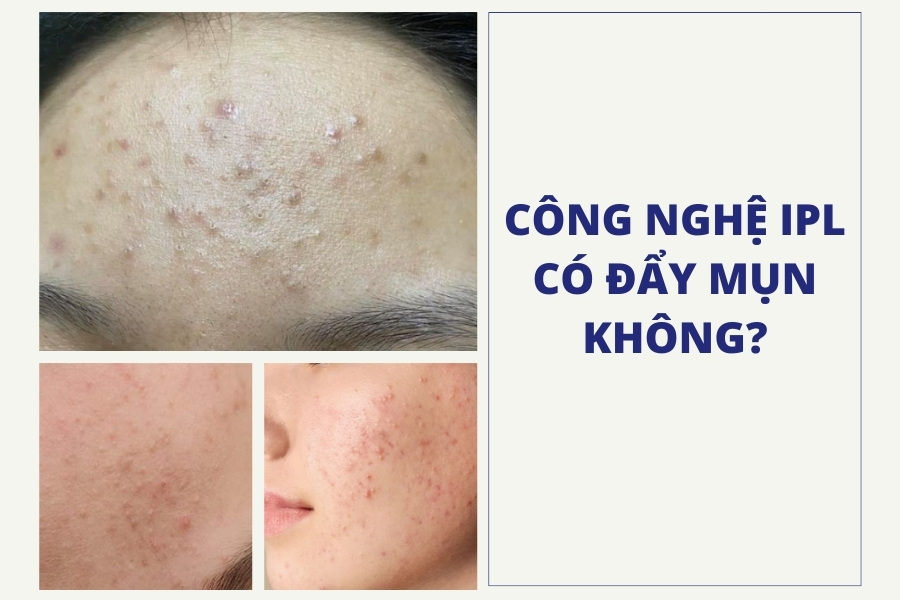 Có thể bắt gặp tình trạng đẩy mụn sau khi sử dụng IPL