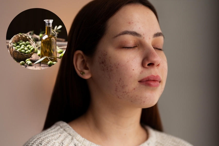 Tình trạng mụn viêm, mụn đầu đen là một trong những tác hại của dầu oliu với da mặt da bị mụn viêm do dùng dầu oliu sai cách
