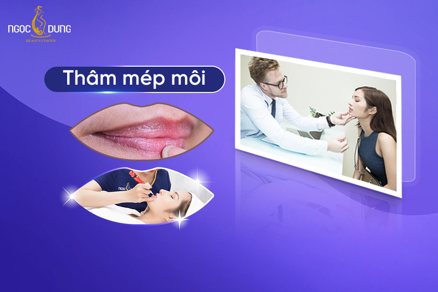 Tại sao mép miệng bị thâm? 7 Cách trị thâm mép môi hiệu quả