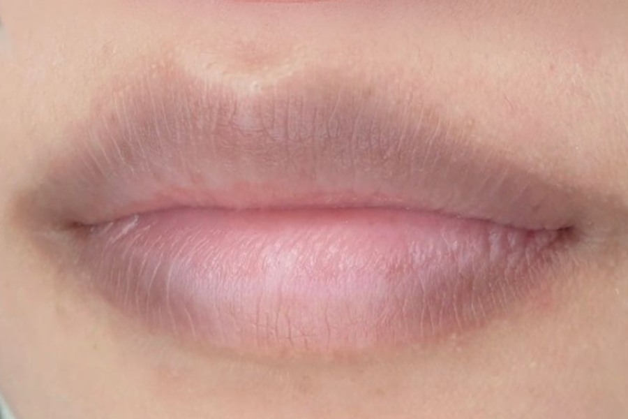 tại sao mép miệng bị thâm nguyên nhân gây thâm mép môi