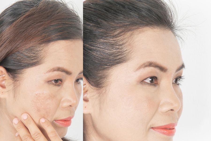 Hình ảnh khách hàng thay đổi ngoạn mục trước và sau khi điều trị đốm nâu tại Ngọc Dung Hình ảnh khách hàng thay đổi ngoạn mục trước và sau khi điều trị đốm nâu tại Ngọc Dung