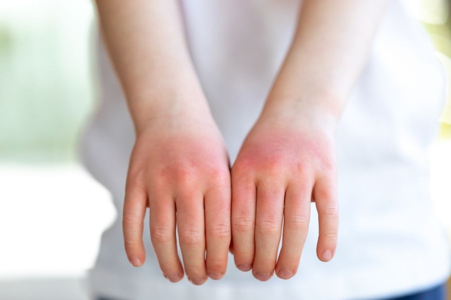 Tay bị lột da do cháy nắng