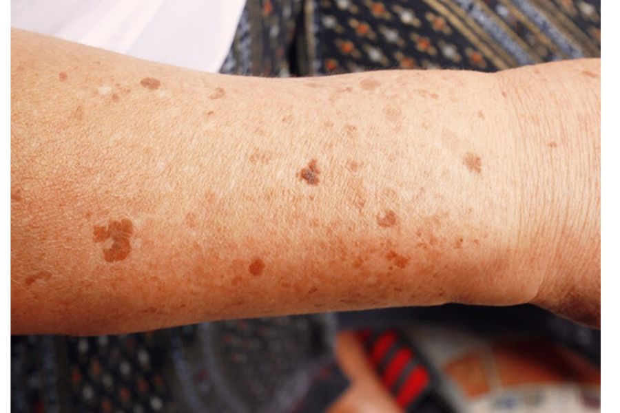 Da tay bị nổi đốm nâu do di truyền từ người thân trong gia đình