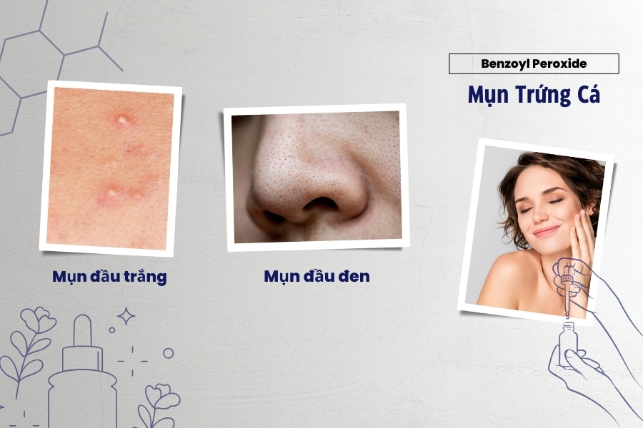 Giảm mụn đầu trắng và đầu đen bằng Benzoyl Peroxide Giảm mụn đầu trắng và đầu đen bằng Benzoyl Peroxide