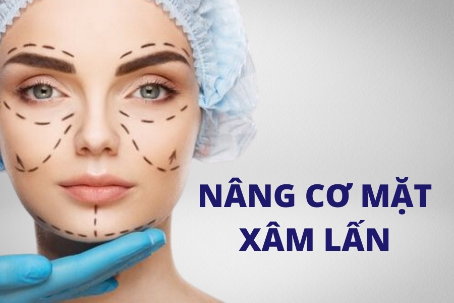 Phẫu thuật nâng cơ mặt sẽ giúp nâng cơ và kéo căng da mặt hoàn toàn