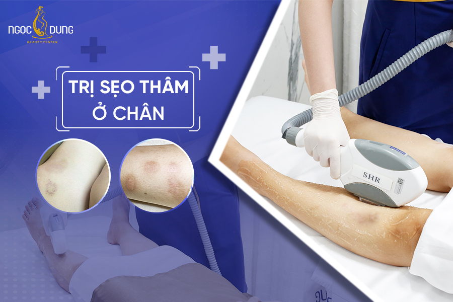 trị sẹo thâm ở chân