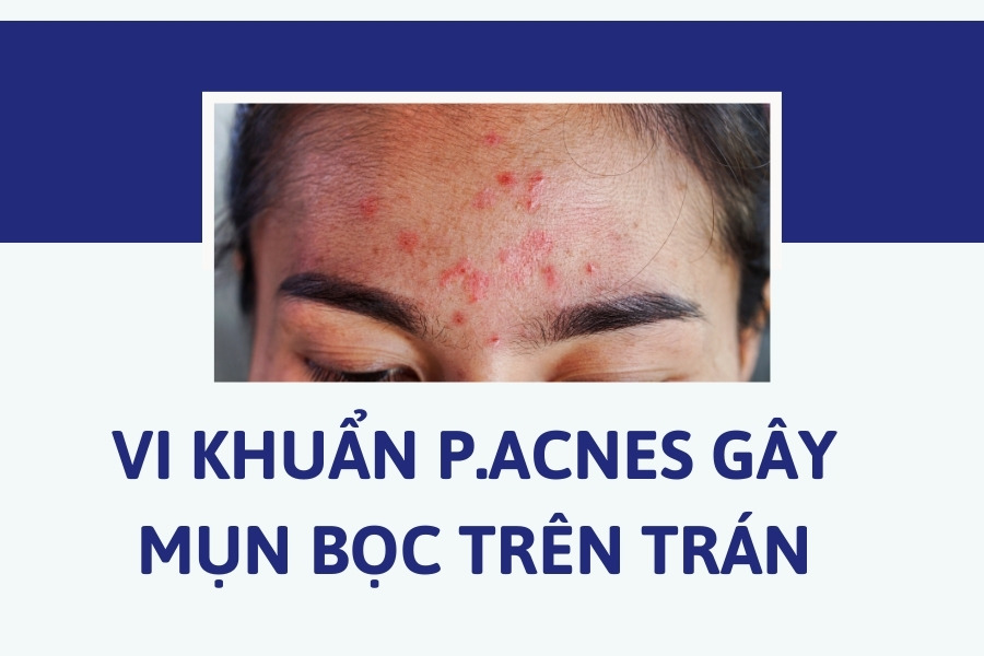 Nguyên nhân và cách trị mụn bọc ở trán sưng to nhanh nhất 3 Vi khuẩn P. Acnes - Thủ phạm chính gây mụn bọc trên trán