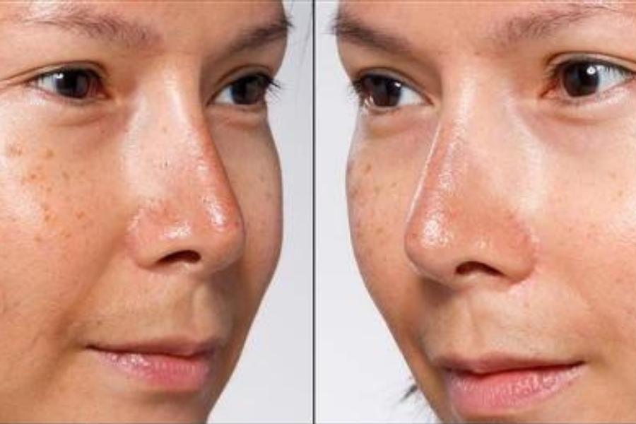 Nếu bị đốm nâu trên mặt phải làm sao?