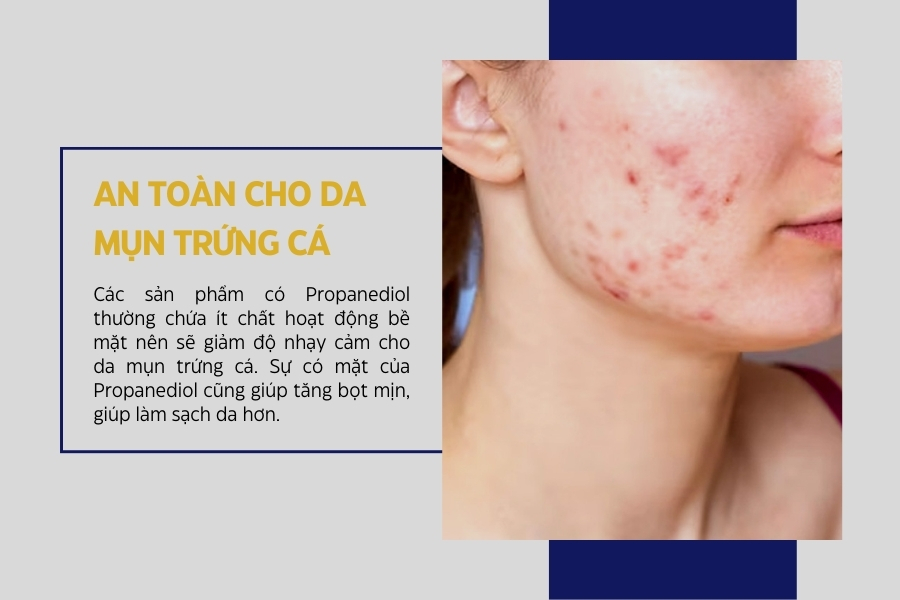 An toàn và tốt cho da dễ bị mụn trứng cá An toàn và tốt cho da dễ bị mụn trứng cá