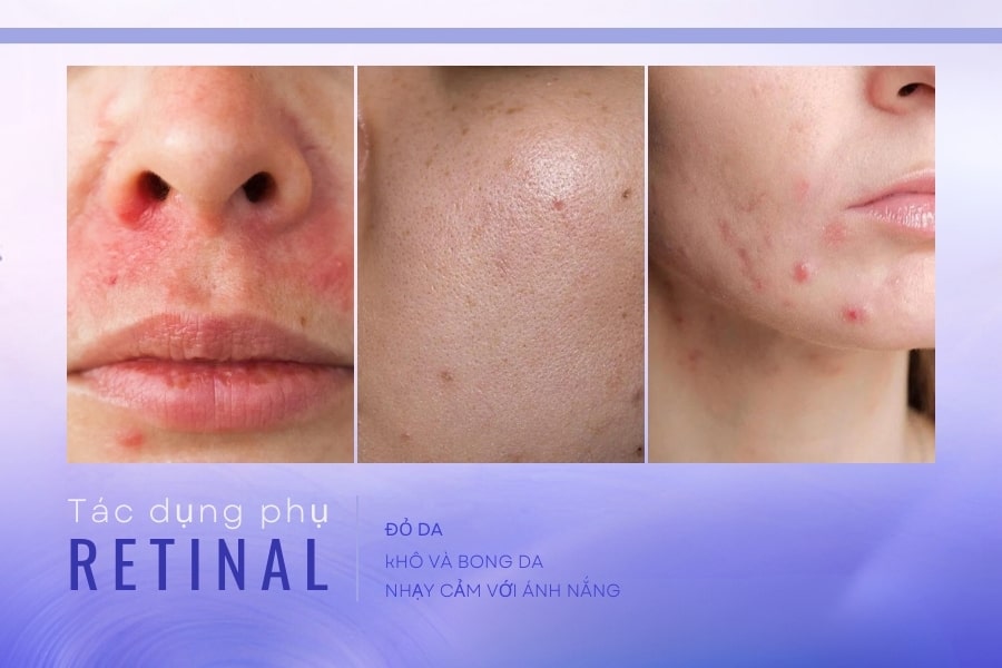 Tác dụng phụ của Retinal là gì? Tác dụng phụ của Retinal là gì?