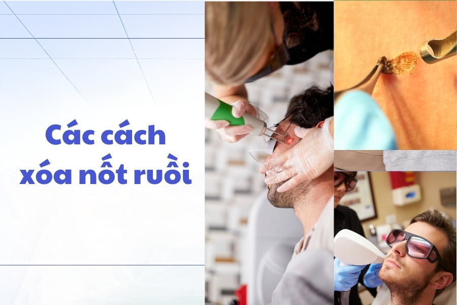 Cách hóa giải những nốt ruồi xấu trên mặt đàn ông