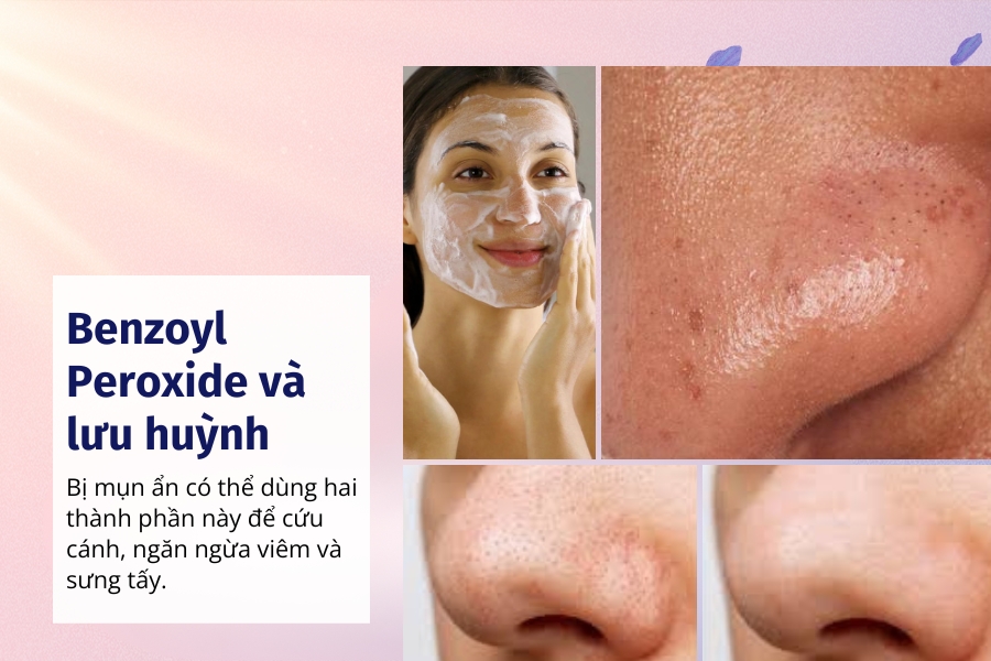 Giảm mụn ẩn trên mũi với Sulfur lưu huỳnh Giảm mụn ẩn trên mũi với Sulfur lưu huỳnh