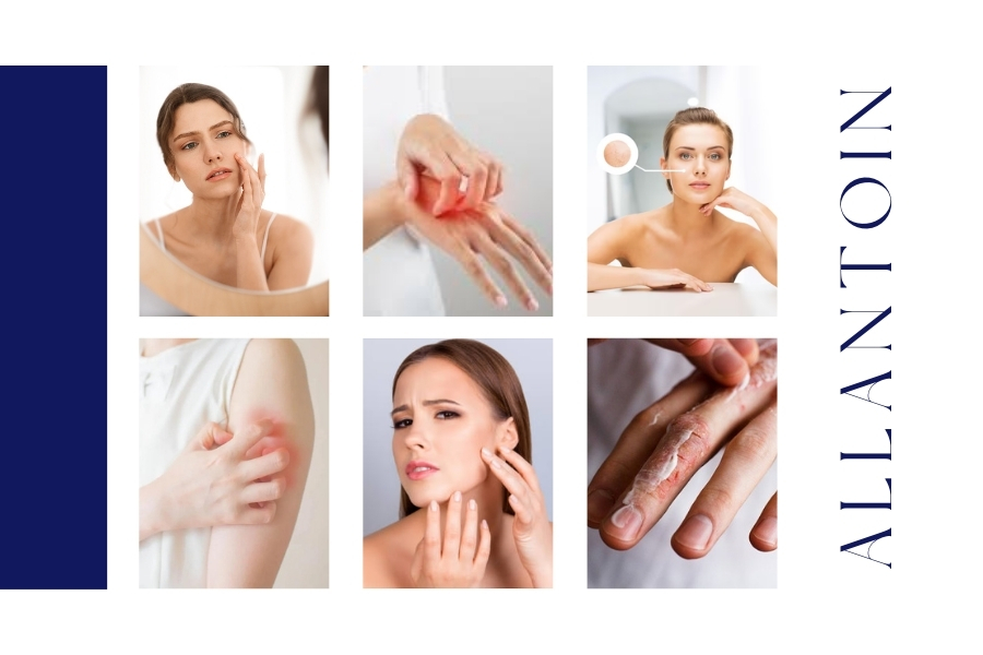 Ai nên sử dụng Allantoin trong mỹ phẩm?