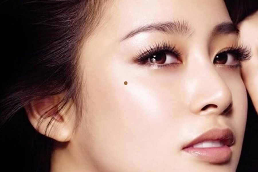 Nốt ruồi ở gò mà là một trong những nốt ruồi xấu trên khuôn mặt phụ nữ