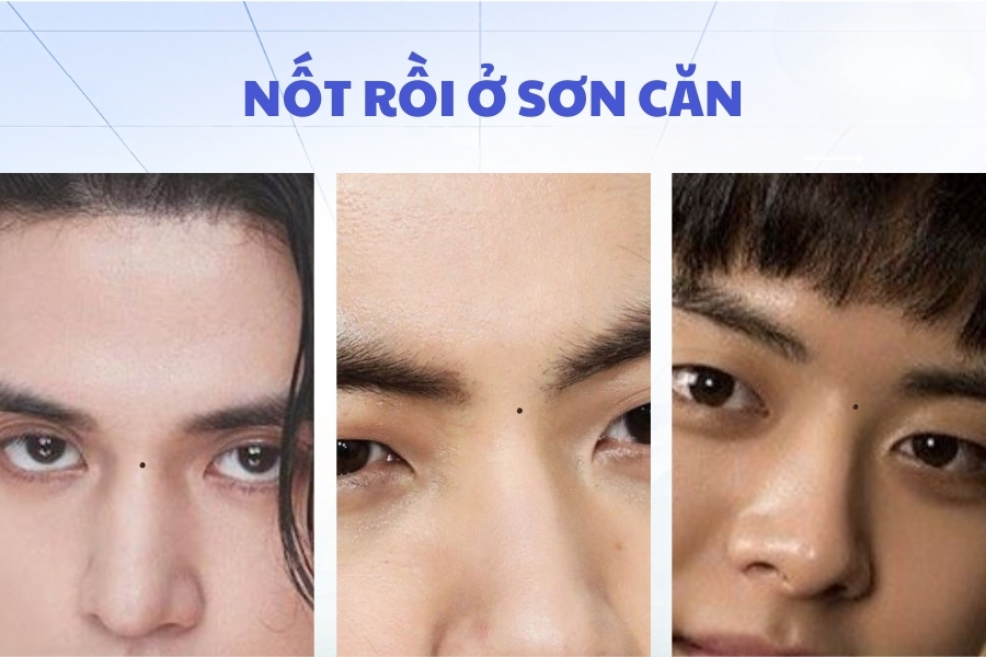 Nốt ruồi ở sơn căn - Điềm báo không may