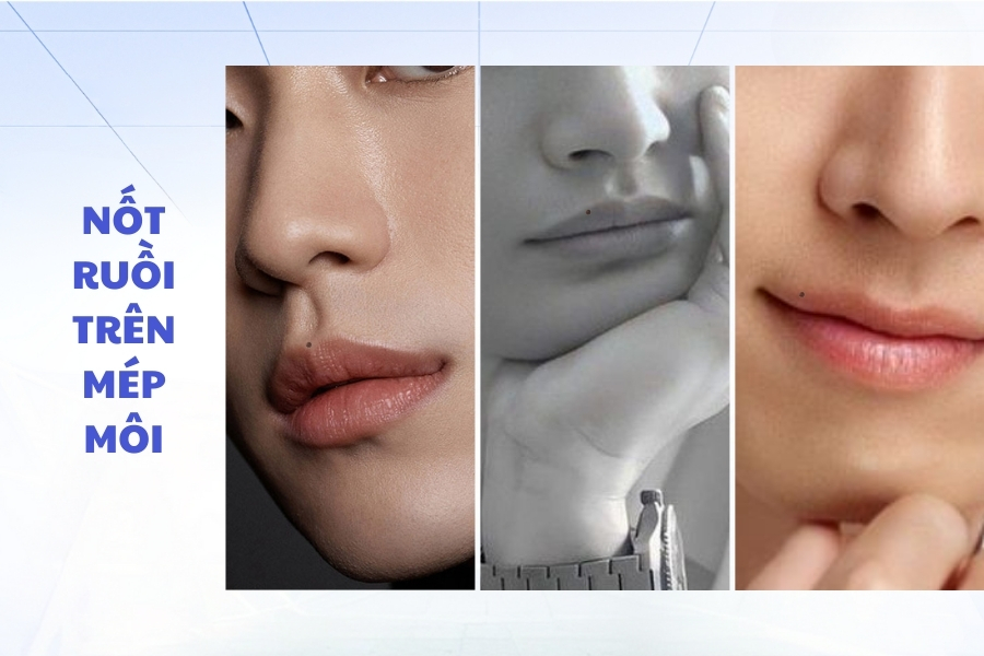 Nốt ruồi ở trên mép môi - Trái phải đều không tốt