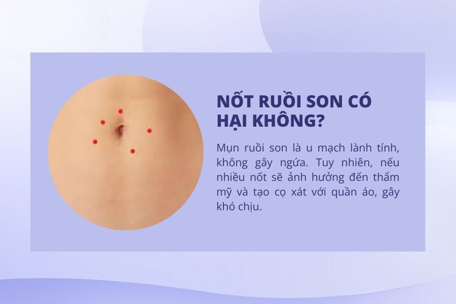 Nốt ruồi son có hại không? Nốt ruồi son có hại không?
