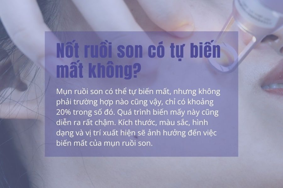 Nốt ruồi son có tự biến mất không? Nốt ruồi son có tự biến mất không?
