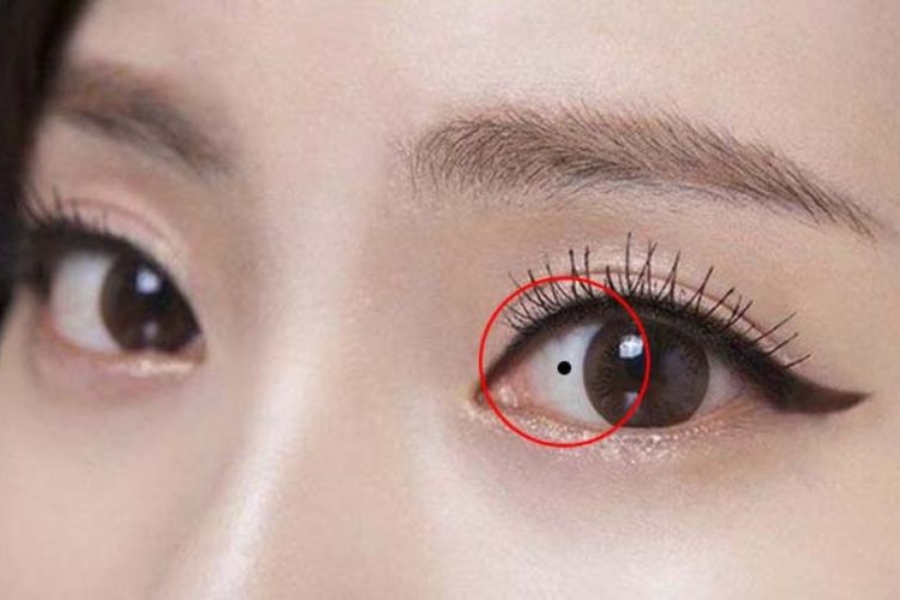 Nốt ruồi trong lòng trắng mắt - Khó bề yên ổn