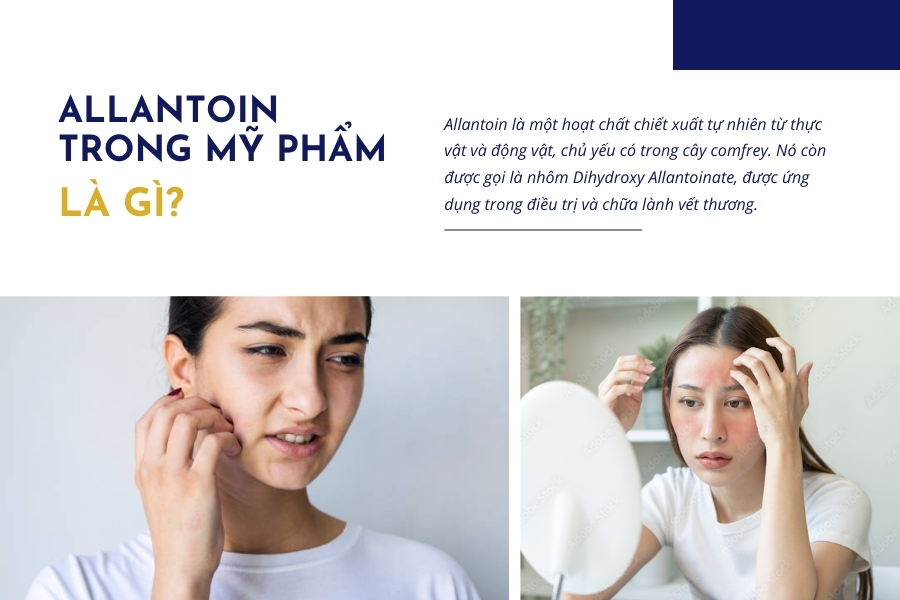 Allantoin là chất gì trong mỹ phẩm dưỡng da?