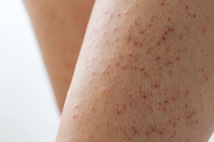 Tình trạng dày sừng nang lông thường hình thành do sự tích tụ của keratin