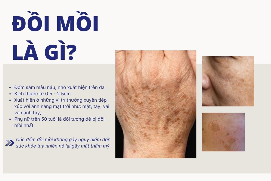 Đồi mồi là những đốm sẫm màu nâu, nhỏ xuất hiện trên da với kích thước từ 0.5 - 2.5cm