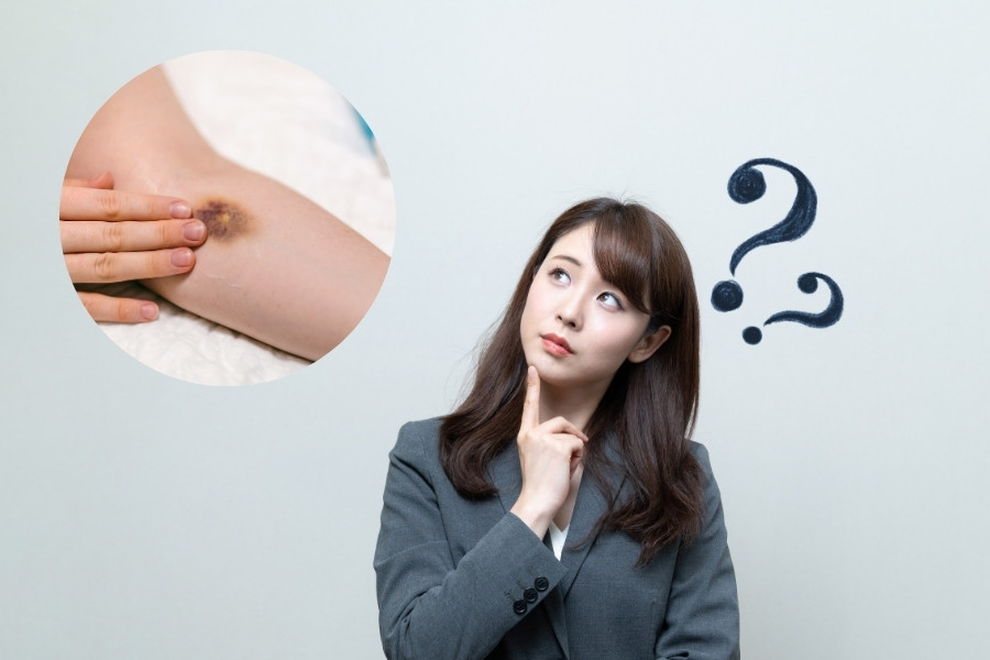 Hầu hết những vết bầm tím chỉ kéo dài đến khoảng 2 tuần