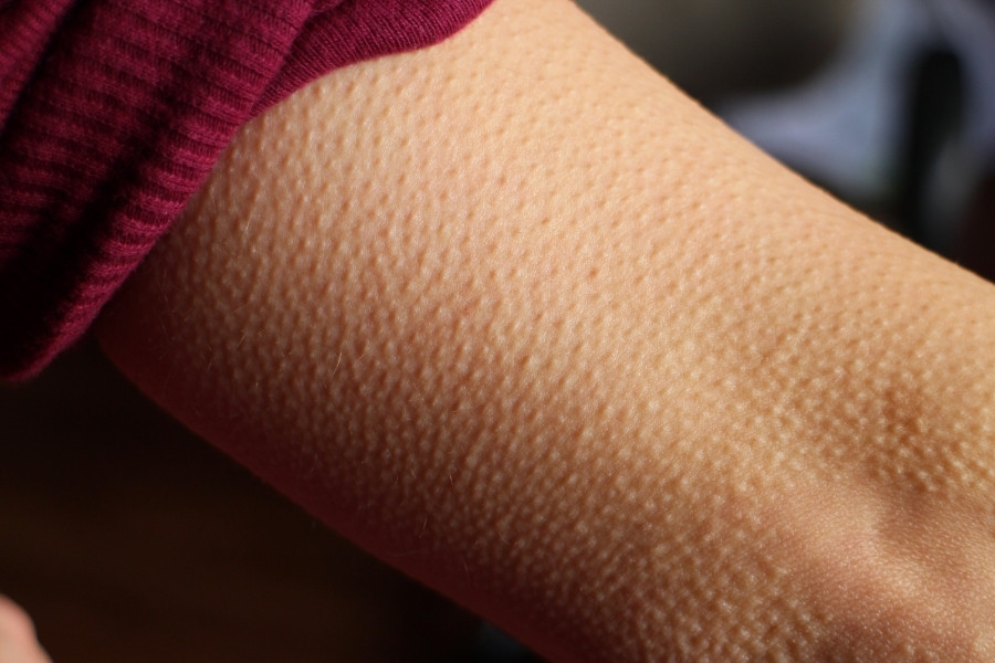 Nguyên nhân khiến bề mặt bị sần sùi như gai ốc vẫn chưa được xác định rõ